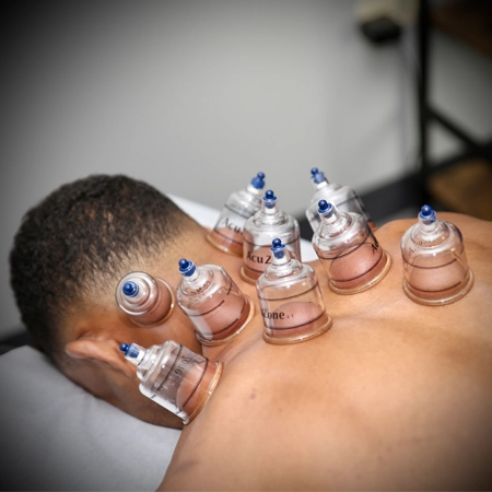 Chiropractic Downers Grove IL Cupping