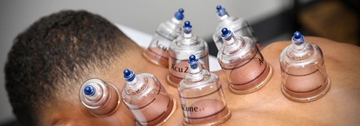 Chiropractic Downers Grove IL Cupping